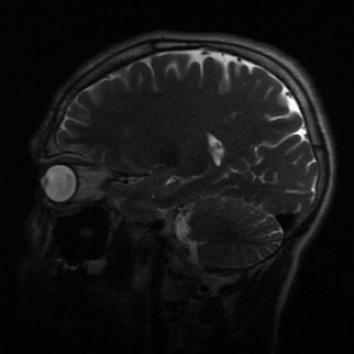 AnEpilepticsPoetics